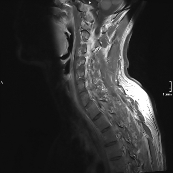 File:Cervical dural CSF leak on MRI and CT treated by blood patch (Radiopaedia 49748-54995 Sagittal T1 C+ 8).png
