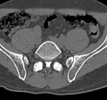 Cervical dural CSF leak on MRI and CT treated by blood patch (Radiopaedia 49748-54996 B 116).png