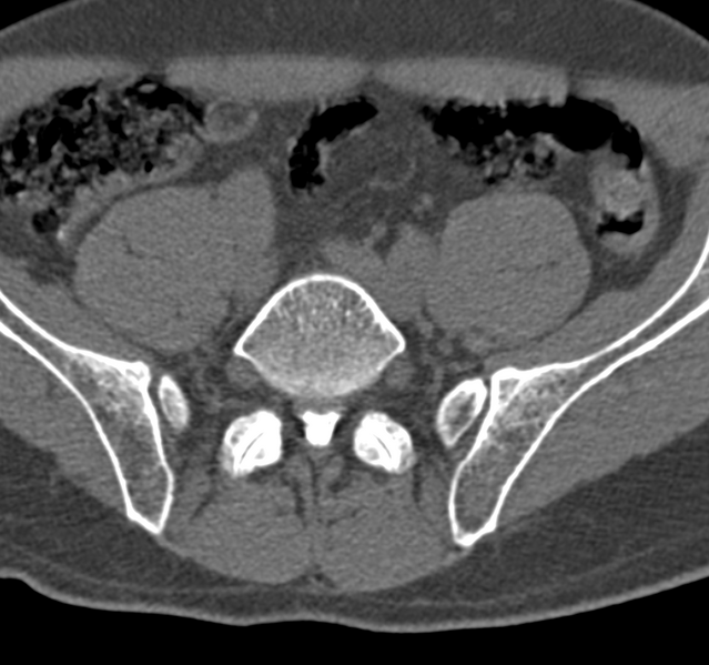 File:Cervical dural CSF leak on MRI and CT treated by blood patch (Radiopaedia 49748-54996 B 116).png