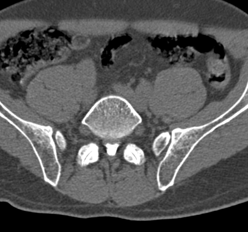 Cervical dural CSF leak on MRI and CT treated by blood patch (Radiopaedia 49748-54996 B 116).png