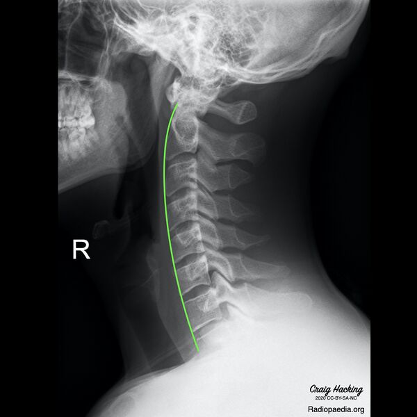 File:Cervical spine lines (Radiopaedia 76069-87571 C 1).jpeg