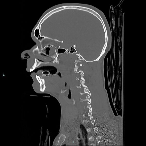 File:Cervical vertebral burst fracture (Radiopaedia 37420-39258 Sagittal bone window 25).jpg
