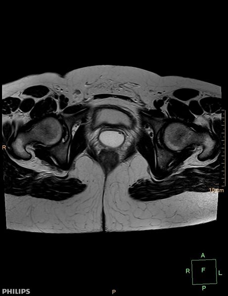 File:Cesarian scar endometriosis (Radiopaedia 68495-78066 Axial T2 21).jpg