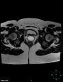Cesarian scar endometriosis (Radiopaedia 68495-78066 Axial T2 21).jpg