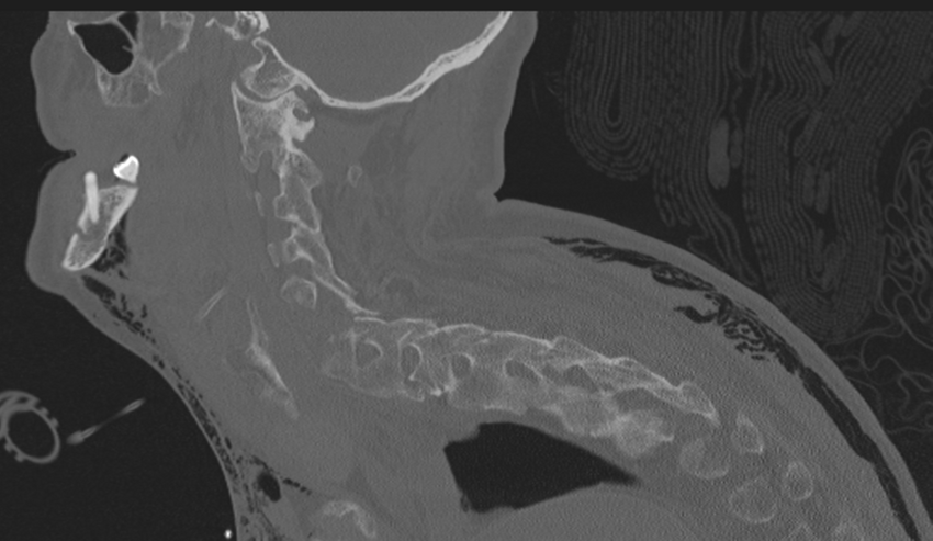 Chalk stick fracture (Radiopaedia 57948-64928 Sagittal bone window 20).png