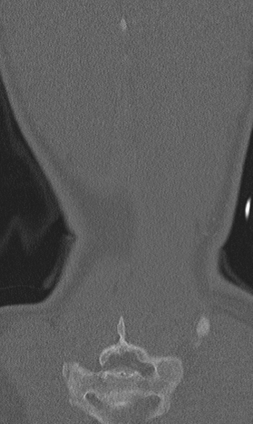 File:Chance fracture (Radiopaedia 40360-42912 Coronal bone window 67).png