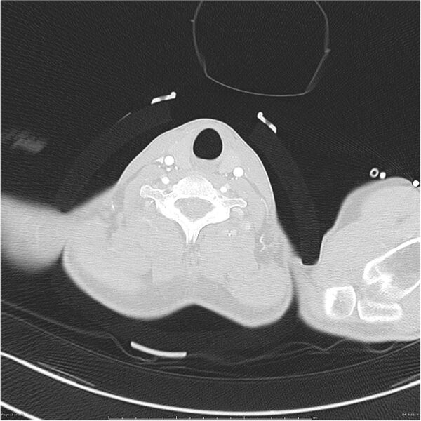 File:Chest and abdomen multi-trauma (Radiopaedia 26294-26425 lung window 3).jpg