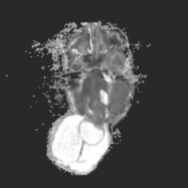 File:Chiari III malformation with occipital encephalocele (Radiopaedia 79446-92559 Axial ADC 10).jpg
