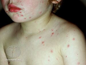 Chickenpox (DermNet NZ viral-varicella103).jpg