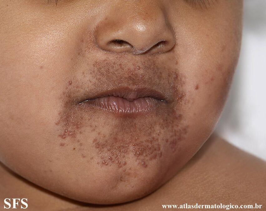 Childhood Granulomatous Periorificial Dermatites (Dermatology Atlas 1).jpg