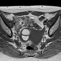 Chocolate cysts (endometriomata) (Radiopaedia 25072-25329 Axial T1 1).jpg