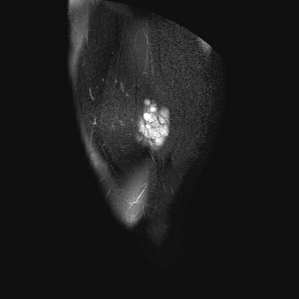 File:Chondrosarcoma arising from exostosis (Radiopaedia 59996-67686 C 1).jpg