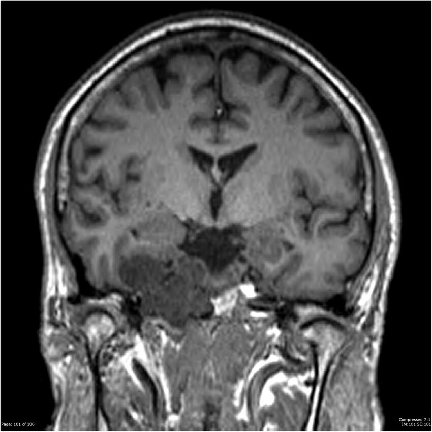 Chondrosarcoma of skull base- grade II (Radiopaedia 40948-43654 Coronal T1 22).jpg