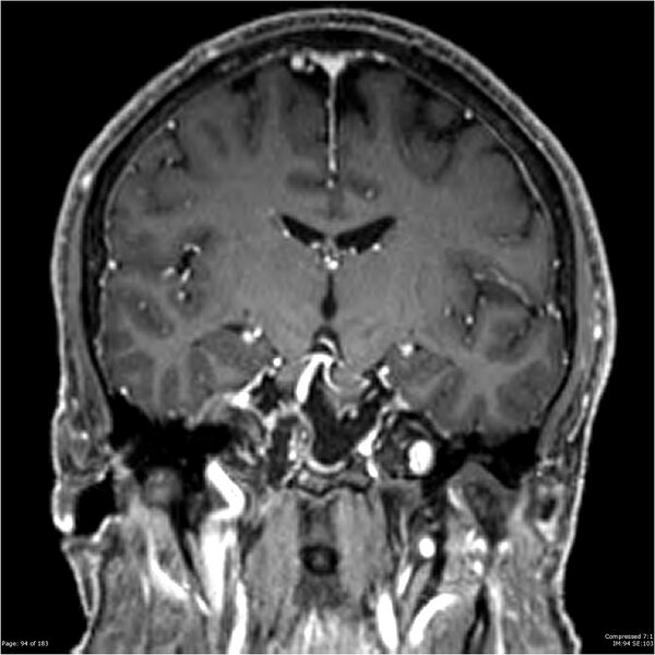 File:Chondrosarcoma of skull base- grade II (Radiopaedia 40948-43654 Coronal T1 C+ 5).jpg