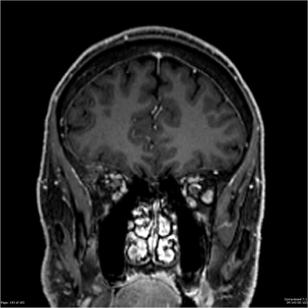 File:Chondrosarcoma of skull base- grade II (Radiopaedia 40948-43654 Coronal T1 C+ 54).jpg