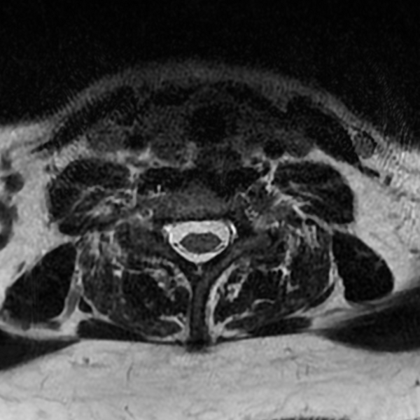 File:Chordoma - cervical spine (Radiopaedia 70084-80111 Axial T2 72).png