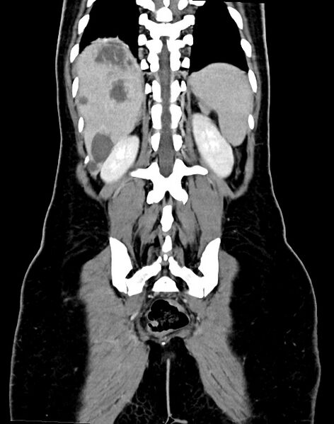 File:Choriocarcinoma liver metastases (Radiopaedia 74768-85766 B 79).jpg