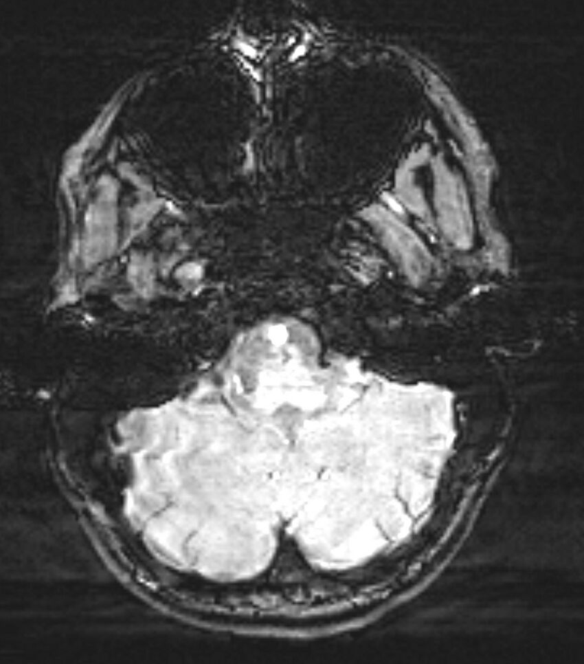 Choroid plexus carcinoma (Radiopaedia 91013-108553 Axial SWI 18).jpg
