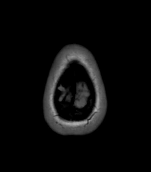 File:Choroid plexus carcinoma (Radiopaedia 91013-108553 Axial T1 158).jpg