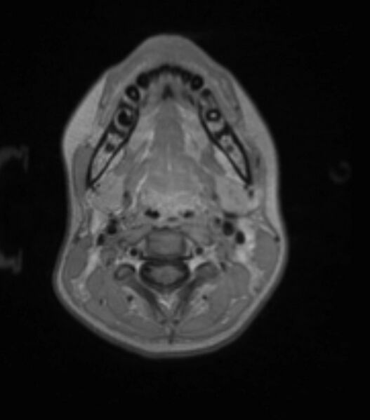 File:Choroid plexus carcinoma (Radiopaedia 91013-108553 Axial T1 C+ 31).jpg
