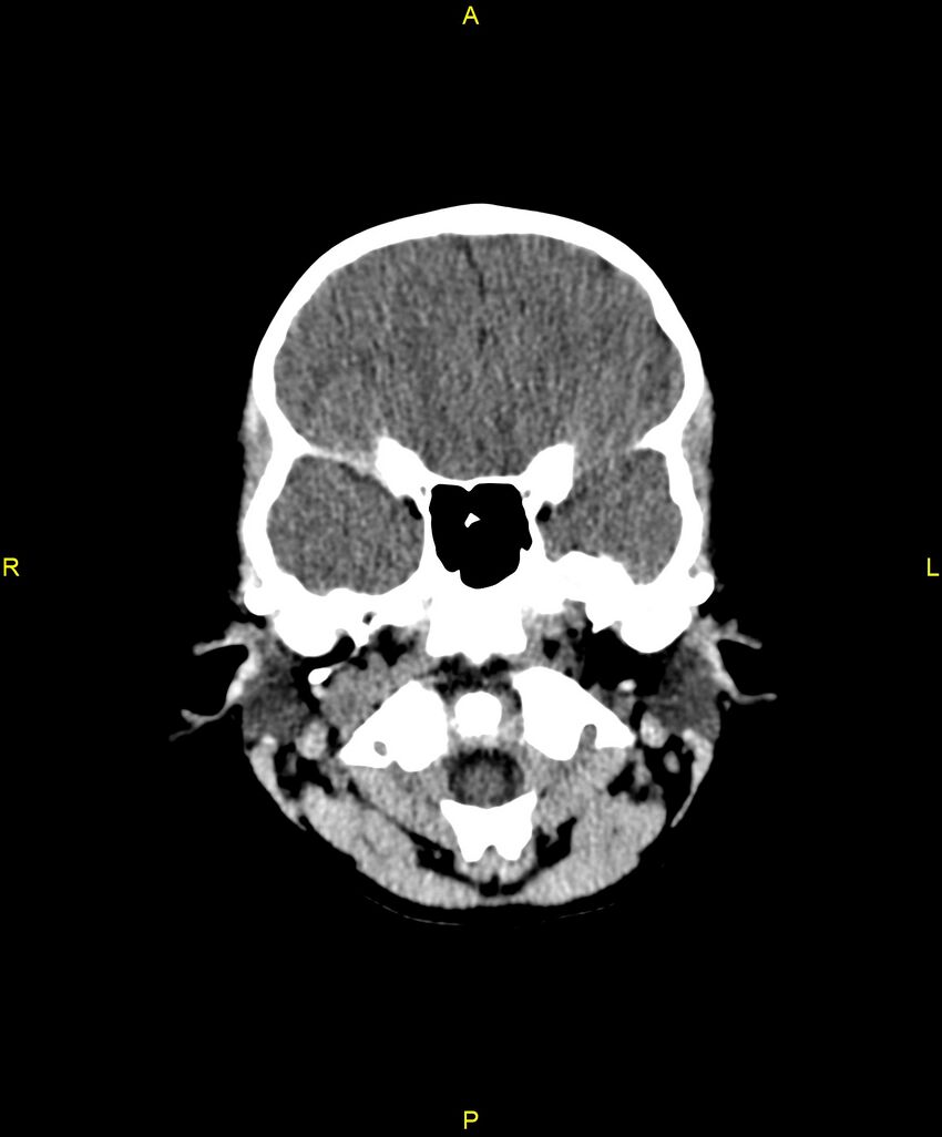 Choroidal fissure cyst (Radiopaedia 89481-106465 Axial non-contrast 26).jpg