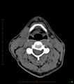 Chronic Submandibular sialolithiasis (Radiopaedia 16880-16606 Axial non-contrast 23).jpg
