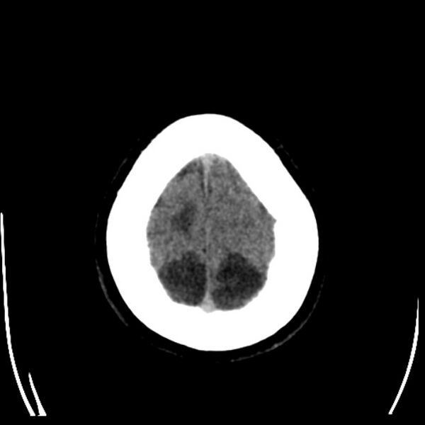 File:Chronic bilateral occipital lobe infarcts (Radiopaedia 31276-31996 Axial non-contrast 39).jpg