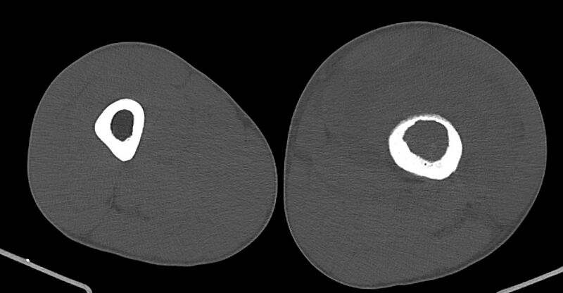 File:Chronic osteomyelitis (with sequestrum) (Radiopaedia 74813-85822 Axial non-contrast 99).jpg