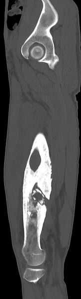 File:Chronic osteomyelitis (with sequestrum) (Radiopaedia 74813-85822 C 79).jpg