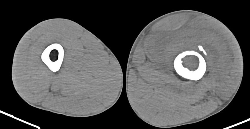 Chronic osteomyelitis (with sequestrum) (Radiopaedia 74813-85822 D 97).jpg