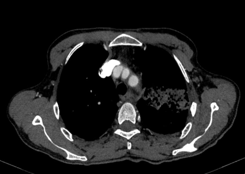File:Chronic pulmonary embolism with bubbly consolidation (Radiopaedia 91248-108850 C+ arterial phase 29).jpg