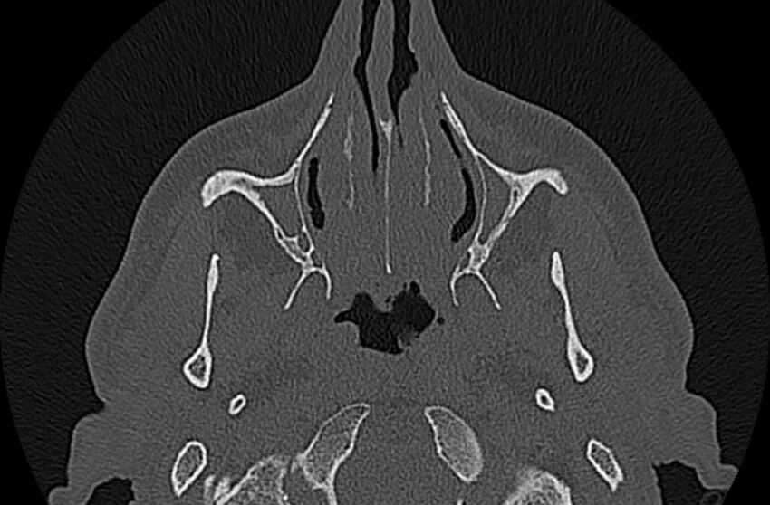 Chronic rhinosinusitis (Radiopaedia 65079-74075 Axial bone window 18).jpg