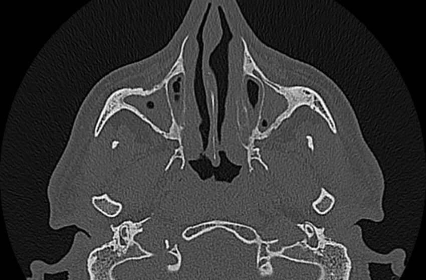 Chronic rhinosinusitis (Radiopaedia 65079-74075 Axial bone window 25).jpg