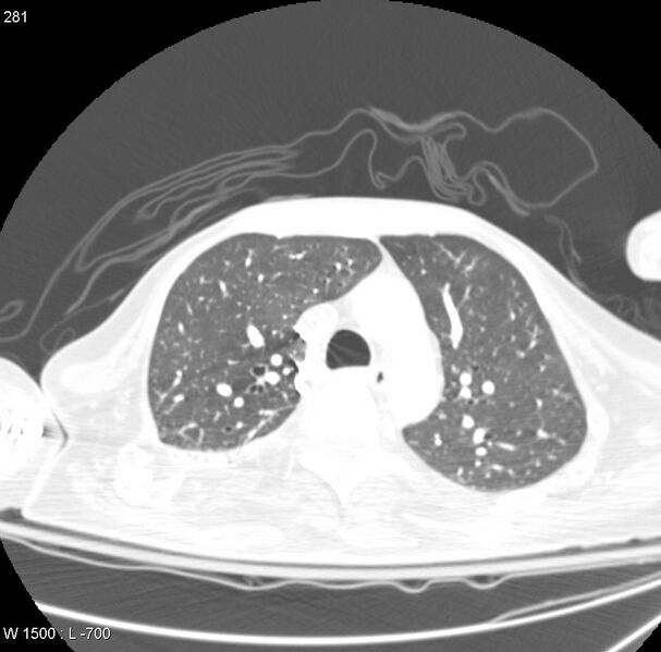 File:Clagett thoracotomy (Radiopaedia 8568-9403 Axial lung window 12).jpg