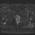Class II Mullerian duct anomaly- unicornuate uterus with rudimentary horn and non-communicating cavity (Radiopaedia 39441-41755 Axial T2 fat sat 27).jpg