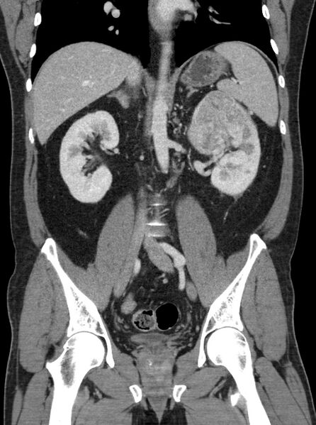 File:Clear cell renal cell carcinoma (Radiopaedia 61449-69393 F 25).jpg