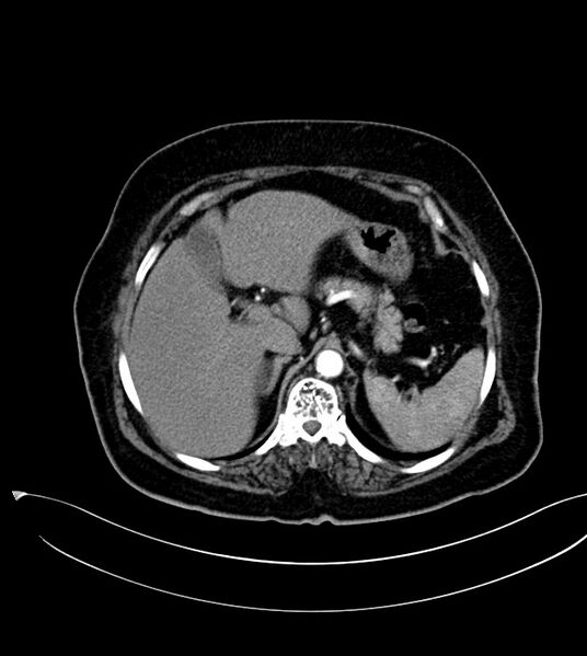 File:Clear cell renal cell carcinoma (Radiopaedia 85004-100537 B 19).jpg
