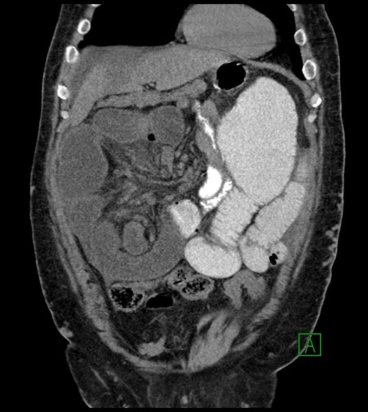 File:Closed-loop small bowel obstruction-internal hernia (Radiopaedia 78439-91096 Coronal non-contrast 33).jpg