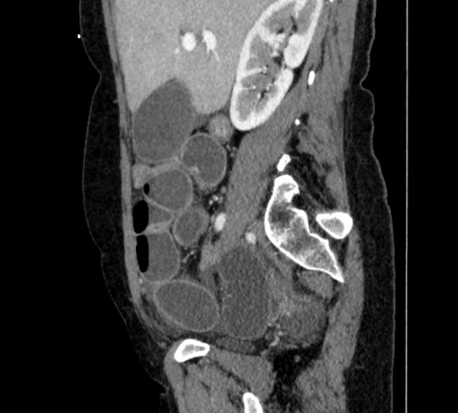 File:Closed loop small bowel obstruction (Radiopaedia 71211-81508 C 41).jpg