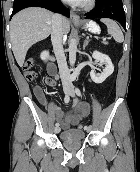 File:Closed loop small bowel obstruction - internal hernia (Radiopaedia 57806-64778 A 58).jpg