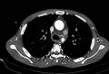 Coarctation of aorta with aortic valve stenosis (Radiopaedia 70463-80574 A 55).jpg