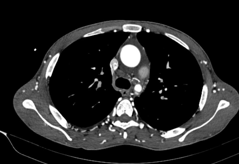 File:Coarctation of aorta with aortic valve stenosis (Radiopaedia 70463-80574 A 55).jpg