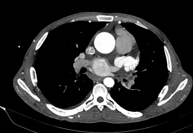 File:Coarctation of aorta with aortic valve stenosis (Radiopaedia 70463-80574 A 94).jpg