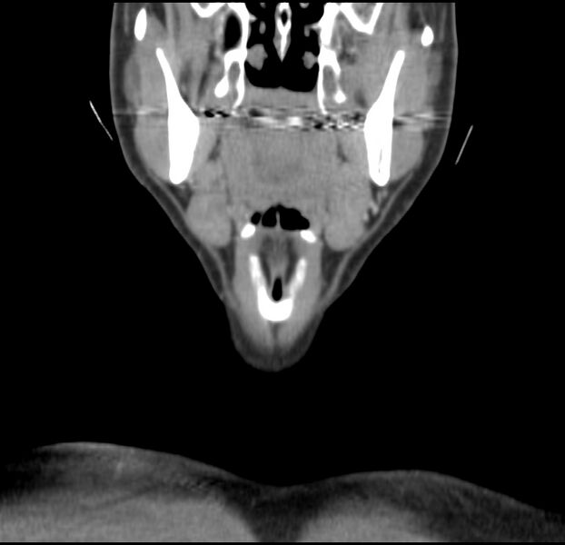 File:Colloid cyst of thyroid (Radiopaedia 22897-22923 Coronal C+ delayed 20).jpg