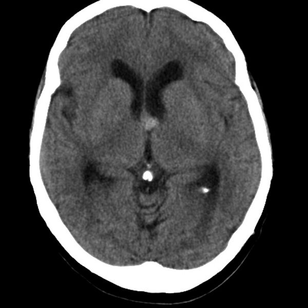 File:Colloid cyst with hydrocephalus (Radiopaedia 9373-10064 Axial non-contrast 10).jpg