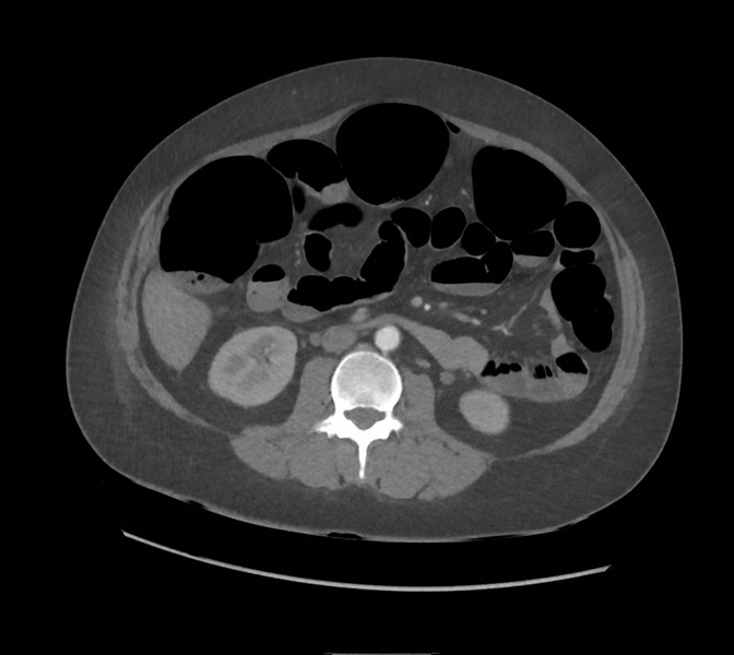 File:Colonic pseudo-obstruction (Radiopaedia 79752-92980 A 92).png