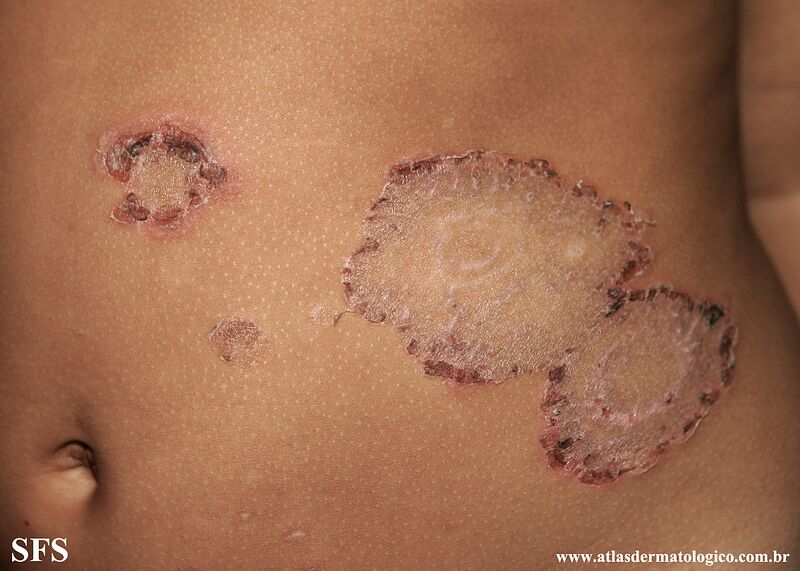 File:Impetigo (Dermatology Atlas 79).jpg