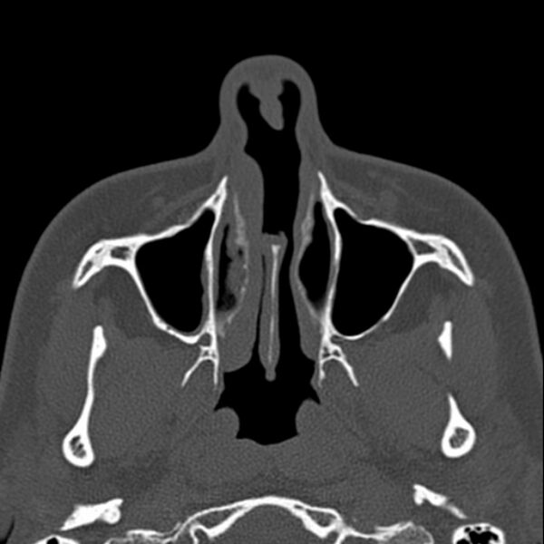 File:Nasal septal perforation (Radiopaedia 25030-25289 Axial bone window 13).jpg
