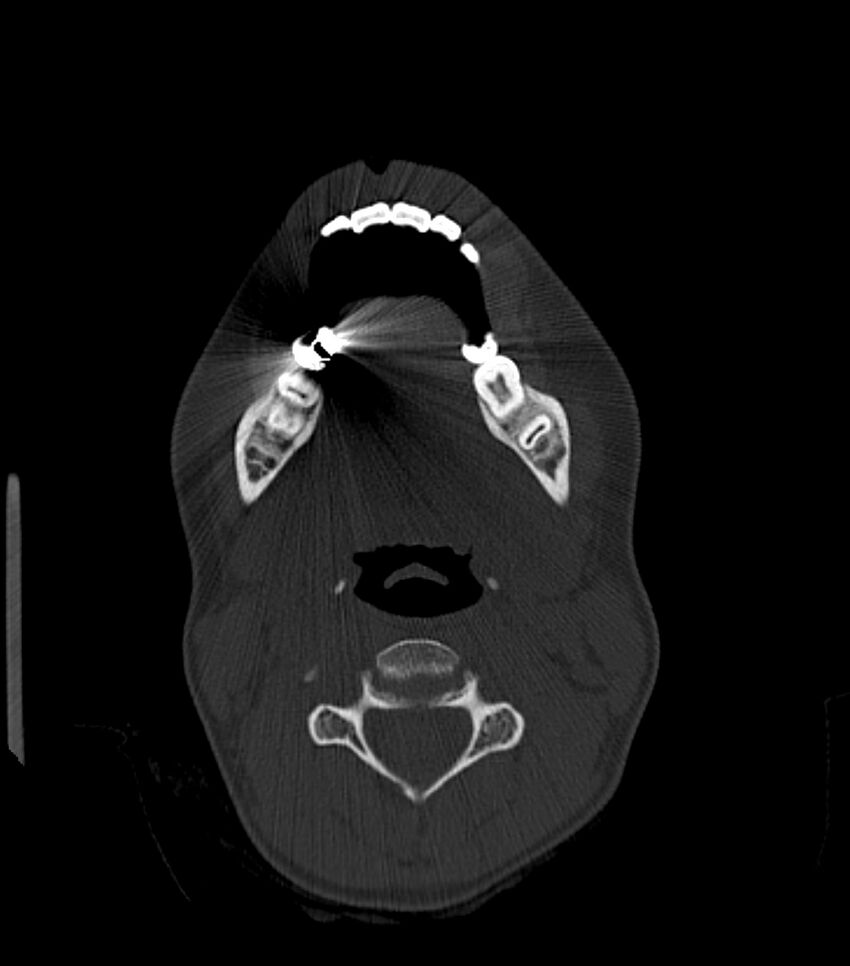Nasoorbitoethmoid fracture (Radiopaedia 90044-107205 Axial bone window 33).jpg