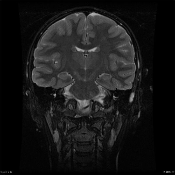 File:Neurofibromatosis type 1 (Radiopaedia 22541-22564 Coronal T2 fat sat 14).jpg